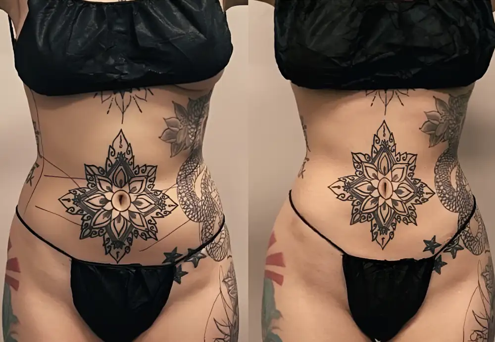 Before: Brazilian Butt Lift (BBL)