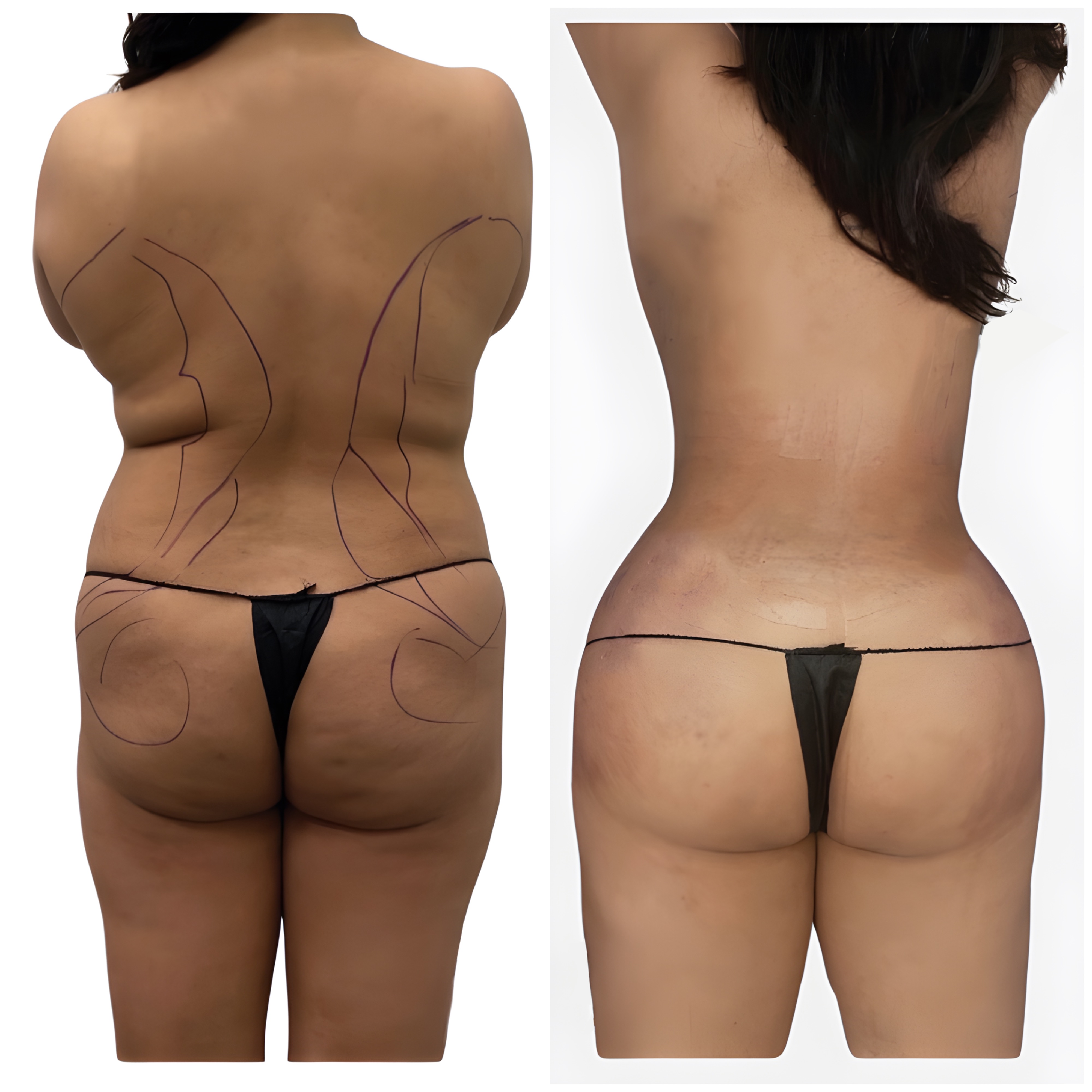 Before: Liposuction 360°