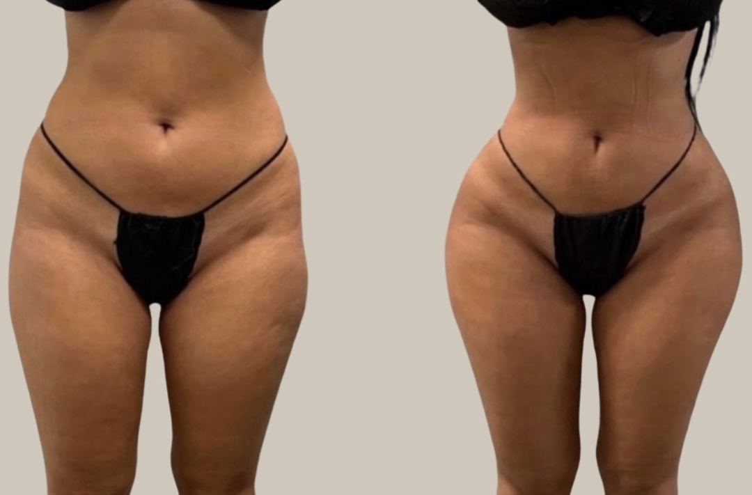 Before: Hip Enhancement